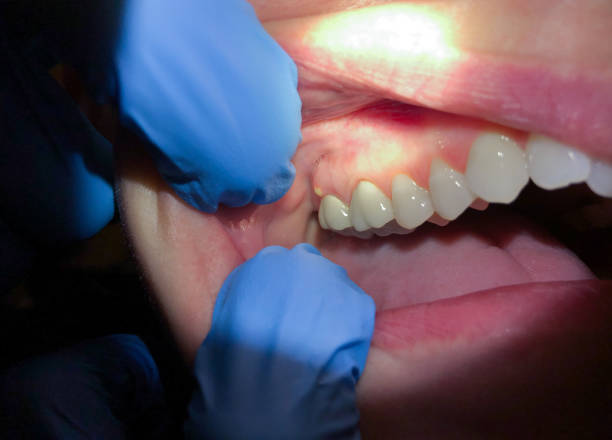 Best Emergency Tooth Extraction in Monroe, GA